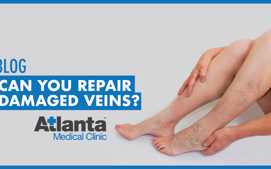 Can You Repair Damaged Veins?
