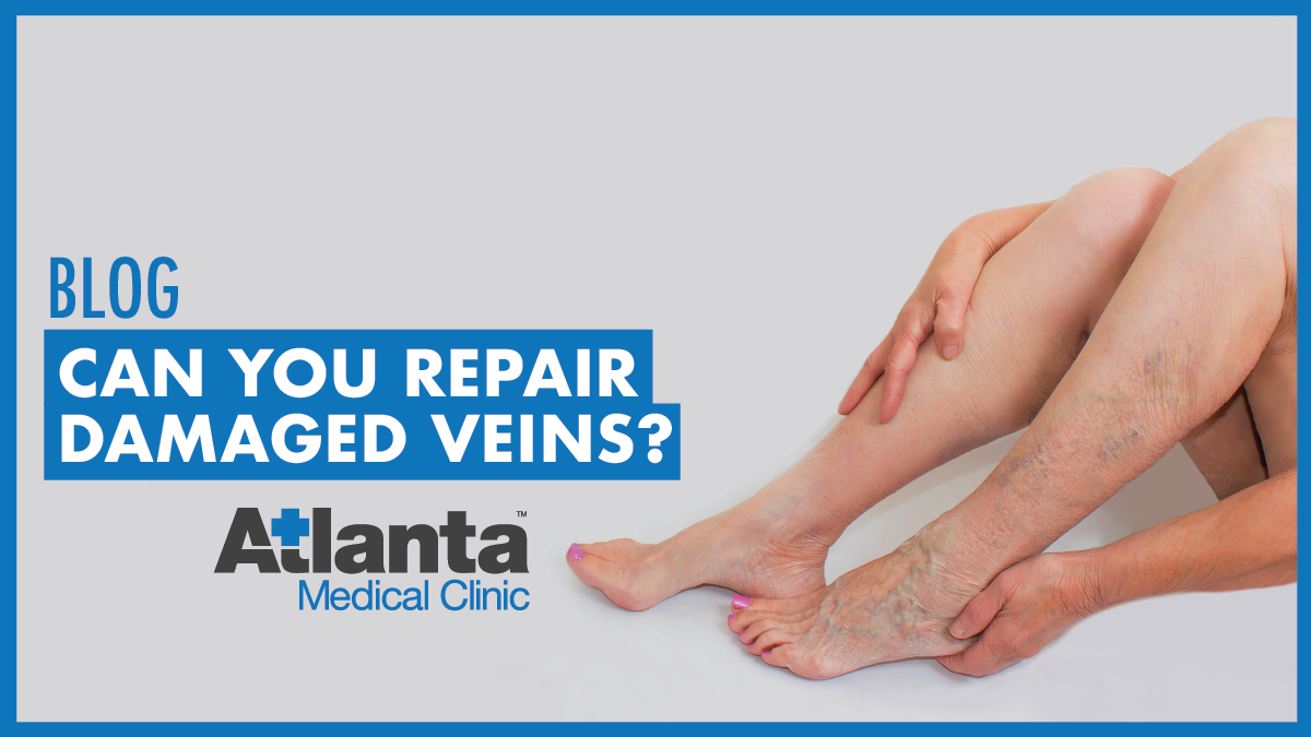 Can You Repair Damaged Veins? Atlanta Medical Clinic