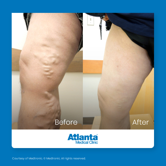 amc-before-and-after-1