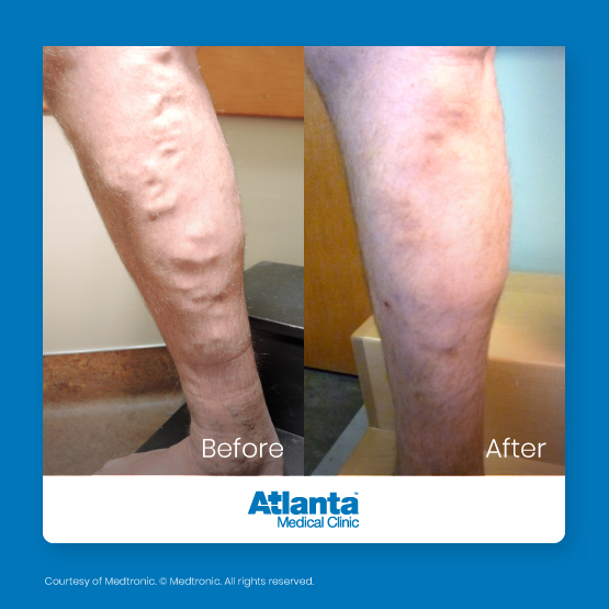amc-before-and-after-2