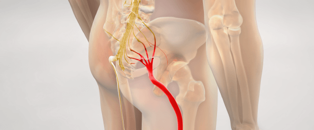 Relief from sciatic nerve pain