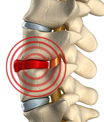 herniated-disc-diagram