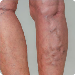 vein treatments in atlanta