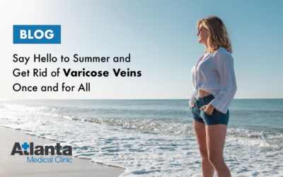 Say Hello to Summer and Get Rid of Varicose Veins Once and For All