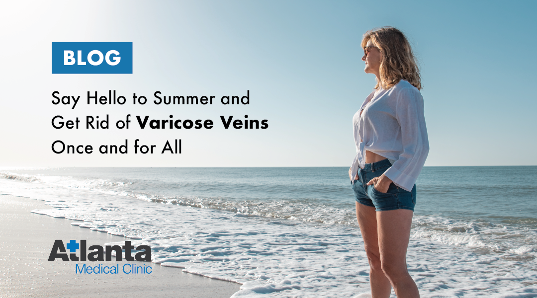 Say Hello to Summer and Get Rid of Varicose Veins Once and For All