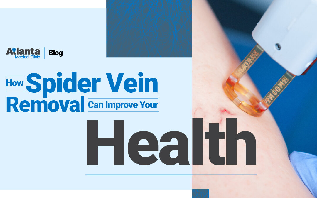 How Spider Vein Removal Can Improve Your Health