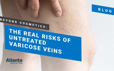 Beyond Cosmetics: The Real Risks of Untreated Varicose Veins