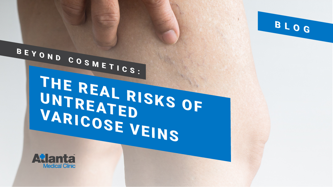 Beyond Cosmetics: The Real Risks of Untreated Varicose Veins