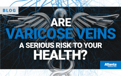 Are Varicose Veins a Serious Risk to Your Health?