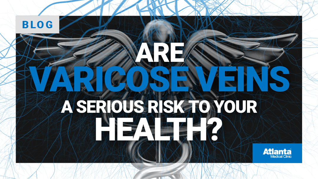 Are Varicose Veins a Serious Risk to Your Health?