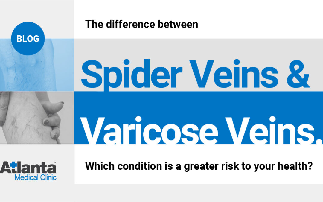 The Difference Between Spider Veins and Varicose Veins