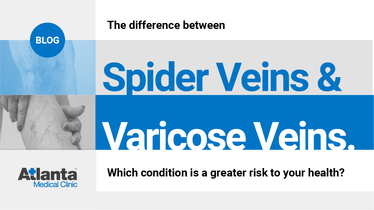 The Difference Between Spider Veins and Varicose Veins The Difference Between Spider Veins and Varicose Veins
