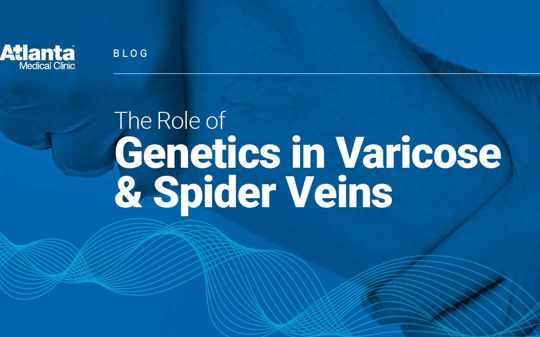 The Role of Genetics in Varicose and Spider Veins