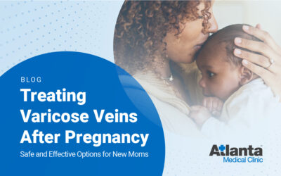 Treating Varicose Veins After Pregnancy: Safe and Effective Options for New Moms