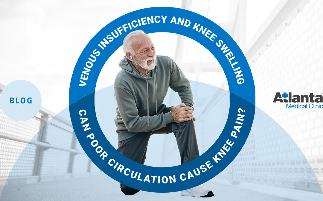 Venous Insufficiency and Knee Swelling: Can Poor Circulation Cause Knee Pain?