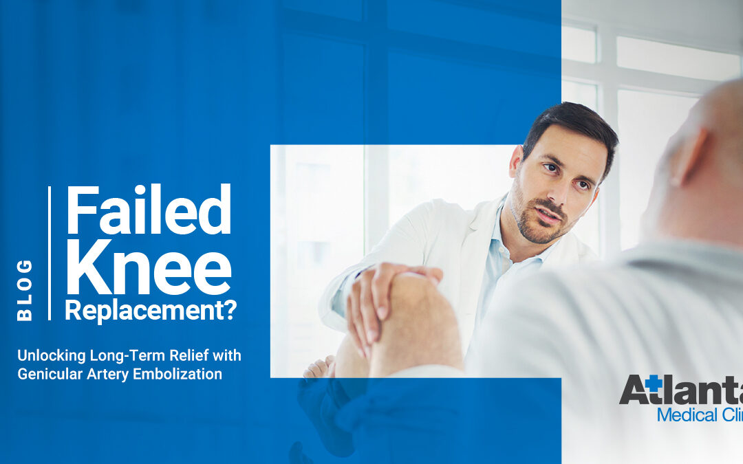 Failed Knee Replacement? Unlocking Long-Term Relief with Genicular Artery Embolization